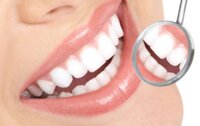 Review tẩy trắng răng bằng thuốc Pola Office có tốt không, chi phí?