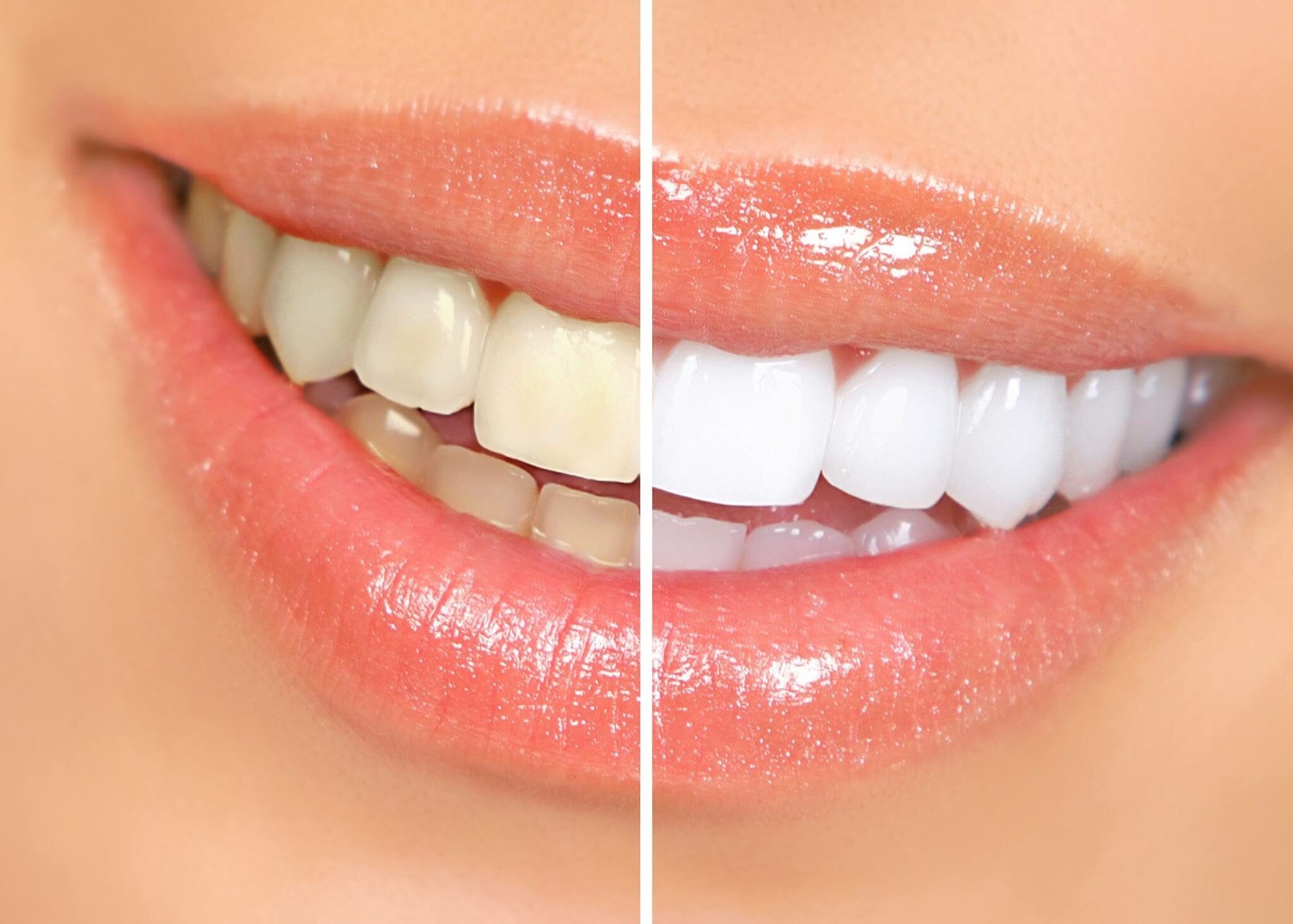 Tẩy trắng răng được bao lâu 1 lần, đau không, cách chăm sóc hiệu quả |  websosanh.vn