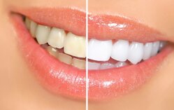Tẩy trắng răng được bao lâu 1 lần, đau không, cách chăm sóc hiệu quả