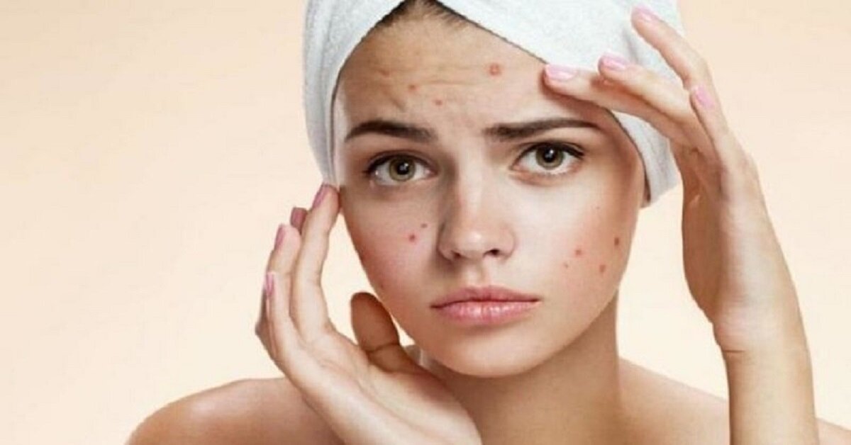 Tiêu chí lựa chọn sữa rửa mặt trị mụn cần biết