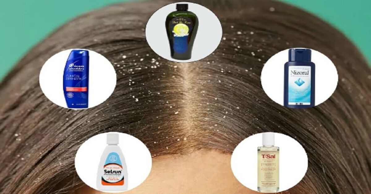 Tiêu chí “vàng” cần biết khi lựa chọn dầu gội trị gàu