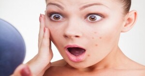 Tổng hợp các dòng sản phẩm sữa rửa mặt trị mụn tốt nhất hiện nay