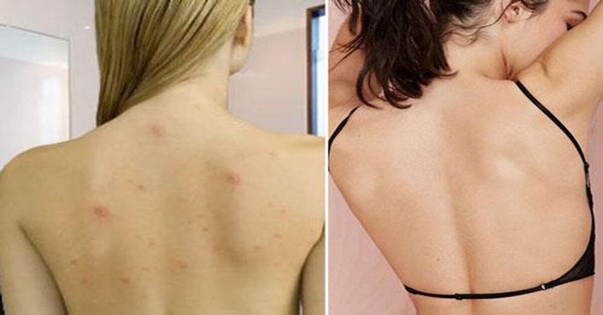 Top 3 sữa tắm trị mụn lưng hiệu quả nhất