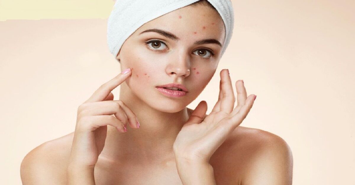 Top 5 kem chống nắng cho da mụn tốt nhất hiện nay