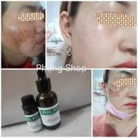 [ 10ml ] Chấm đầy sẹo Rỗ | Peel Tca  | Dùng Chấm Sẹo Rỗ Do Mụn | làm mờ nốt ruồi |tàn nhang, thâm mụn hàng chuẩn