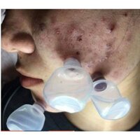 [ 70k -100 ống ] Ống nhựa hút máu bầm