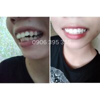 - | Bán Chạy | Dụng Cụ Niềng Răng | Cho người lớn A1 + A2 + A3 + 1 Dây mài kẽ, đánh bóng răng  ¹