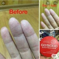 [ HÀNG ĐỨC ] Kem Nẻ Glysolid Hautbalsam, 100 ml