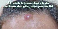 10+ cách trị mụn nhọt ở trán an toàn, đơn giản, hiệu quả tức thì