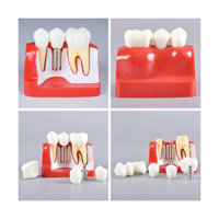 4 Lần Cấy Nha Khoa Răng Phân Tích Mô Hình Vương Miện Cầu Có Thể Tháo Rời Mô Hình Nha Sĩ Thực Hành Học Sinh Nghiên Cứu Mô Hình Răng