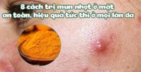 8 cách trị mụn nhọt ở mặt an toàn, hiệu quả tức thì ở mọi làn da