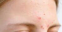 9 cách trị mụn mủ ở trán đơn giản, an toàn, hiệu quả tức thì