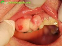 Bài thuốc đặc trị viêm nha chu viêm lợi – Bài thuốc 6 VNC