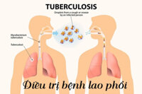 Bệnh Lao Kháng Thuốc Sau Bao Lâu Thì Hết Lây: Hướng Dẫn Chi Tiết