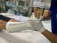 Bó Bột Thủy Tinh Giá Bao Nhiêu? Thông Tin Chi Tiết Cần Biết