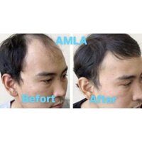Bộ sản Phẩm trị rụng tóc AMLA