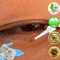 Bút Tẩy Nốt Ruồi, Xóa Mụn Thịt, Tẩy Mụn Cóc, thành phần thiên nhiến hoàn toàn, không đau rát, giá cực rẻ