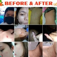 Bút Tẩy Nốt Ruồi, Xóa Mụn Thịt, Tẩy Mụn Cóc, thành phần thiên nhiến hoàn toàn, không đau rát, giá cực rẻ