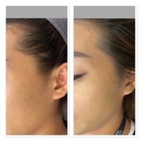 Cấy trắng face + Thải chì hút độc tố