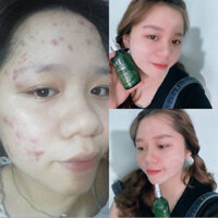 CHAI TÁI TẠO LẺ HẠNH SINOO-HỖ TRỢ TRỊ MỤN -THÂM-SẸO RỖ-NÁM-TÀN NHÀNG.