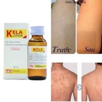 [CHỈ BÁN HÀNG THÁI] LOTION KELLA VIÊM LỖ CHÂN LÔNG,  VIEM DA THÁI LAN