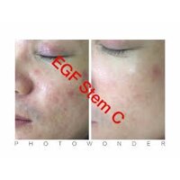 chính hãng tế bào gốc egf  của hãng isov hàn quốc