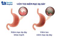 Chữa Bệnh Teo Niêm Mạc Dạ Dày Bằng Thuốc Nam Hiệu Quả và An Toàn