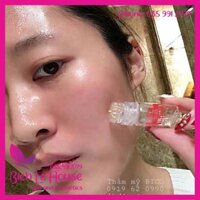 Đầu cấy tinh chất vi điểm tặng tế bào gốc ronas - Spa Bích Lê House