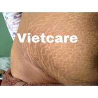Dầu rạn Vietcare