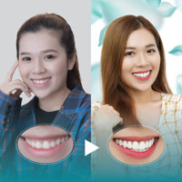 Điều trị dứt điểm hở lợi tại Nha Khoa Thẩm Mỹ Quốc Tế San Dentist