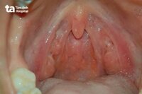 Dùng Thuốc Tây Khó Chữa Dứt Điểm Viêm Họng Hạt: Giải Pháp Toàn Diện