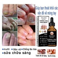 EELHOE 30ml Tinh chất trị nấm móng Làm sạch nấm móng bị tổn thương, nước ăn mòn tay chân, giúp móng chắc khỏe