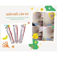 GEL HỖ TRỢ GIẢM MỤN TRETINOIN ARET