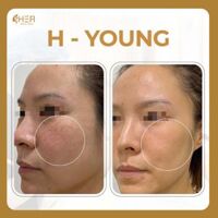 H - YOUNG - Trị liệu trẻ hoá độc quyền da nám, da lão hoá