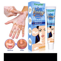 Kem Bôi Bạch Biến, Bạch Tạng Vitiligo ointment Chính Hãng, Hiệu Quả Làm Mờ Bạch Biến Đốm Trắng, Bạch Tạng - 20gr