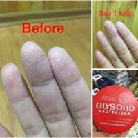 Kem dưỡng da Glysolid của Đức