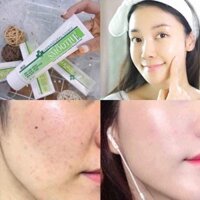 Kem Dưỡng Thâm Mụn Smoothe 15g