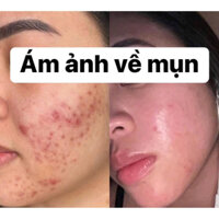 KEM NÁM THUỶ TINH BẠCH