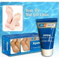 Kem trị nứt gót chân kpem