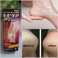 Kem trị nứt gót chân Muhi