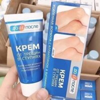 KEM TRỊ NỨT GÓT CHÂN NGA