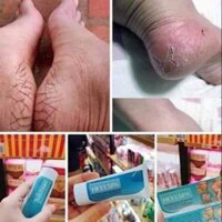 Kem trị nứt gót chân Thailand