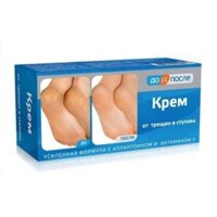 Kem trị nứt gót chân