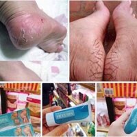 Kem trị nứt gót Heelspa