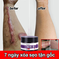 Kem xóa sẹo xóa sẹo cũ sẹo phẫu thuật sẹo bỏng vết rạn da loại bỏ tận gốc các loại sẹo phục hồi da bị tổn thương 30g