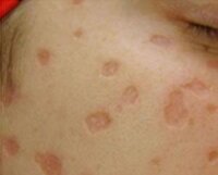 Khi Nào Thì Bôi Thuốc Sẹo Cho Nốt Thủy Đậu Để Ngừa Sẹo