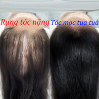 Kích thích mọc tóc Thuốc kích thích mọc tóc Tinh dầu dưỡng tóc 30ml chăm sóc giúp mọc tóc Ngăn Ngừa Tóc Gãy Rụng