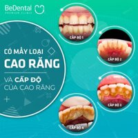 Lấy Cao Răng Cạo vôi răng Và Đánh Bóng Công Nghệ Siêu Âm Mới - Nha khoa BeDental 5 chi nhánh
