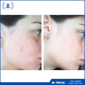 Lotion trị mụn Meishoku Bigansui Medicated Skin Lotion 80ml