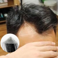 Lzhdp Trán Miếng Dán Tóc Trước Tự Nhiên Nam